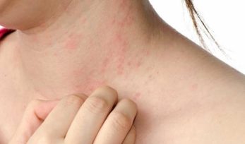 El brote de dengue en Misiones crece de manera muy rápida, los síntomas son fiebre y dolor