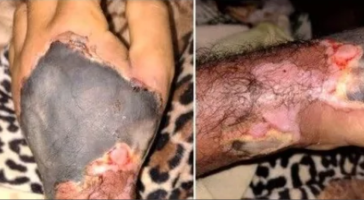 Grave denuncia de mala praxis en Oberá,  «Se le está pudriendo la mano a mi papá»