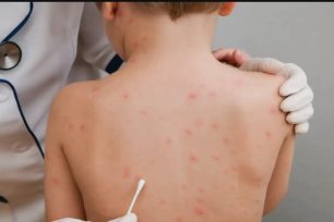 Brote de varicela en Paraguay, la alerta sanitaria llega a Misiones para monitorear los casos en la frontera