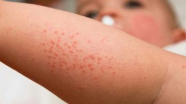 Misiones aprobó por ley un programa de abordaje de la dermatitis atópica