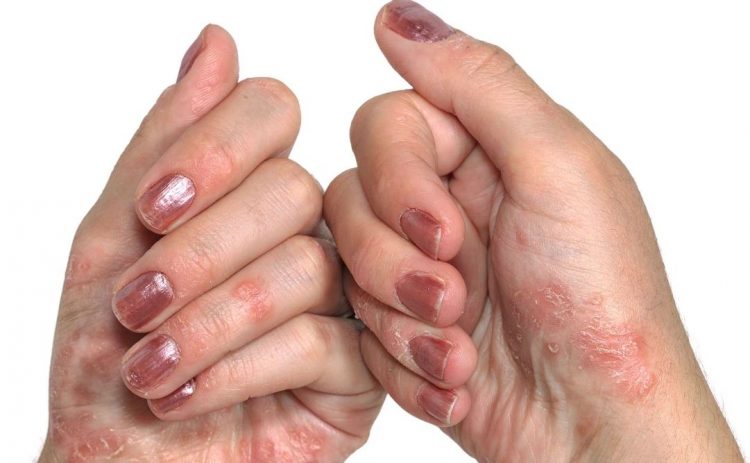La ANMAT aprobó un nuevo medicamento para la psoriasis moderada a severa