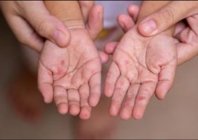 Advierten un aumento de casos por el virus de la enfermedad mano-boca-pie que afecta a niños