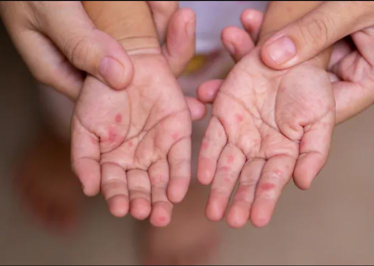 Advierten un aumento de casos por el virus de la enfermedad mano-boca-pie que afecta a niños