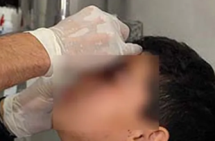 Un nene mordió un petardo y le explotó en la cara en Navidad